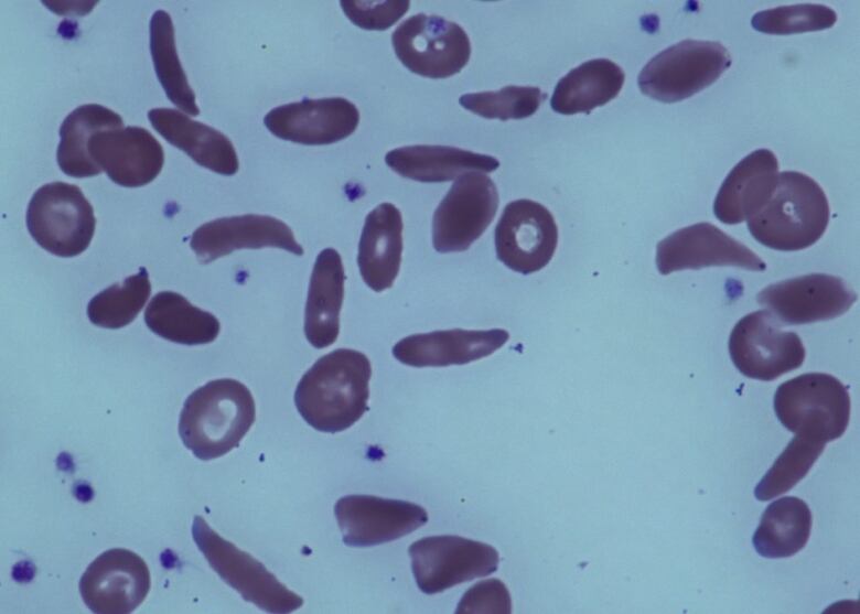 Red blood cells affected by sickle cell disease.