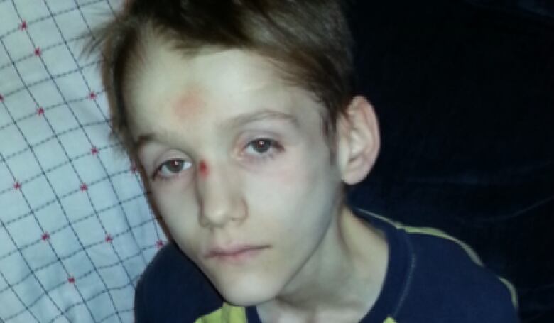 A gaunt-looking teenage boy has soars on his nose and forehead.