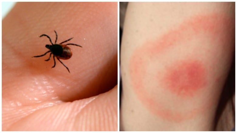 A blacklegged tick and a bite mark