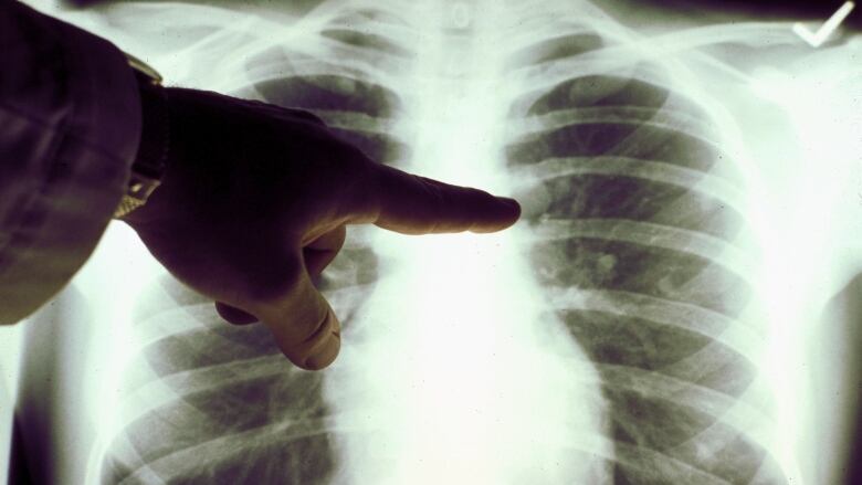 Finger points at an x-ray of a lung