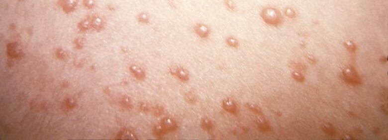 Close up view of shingles rash.