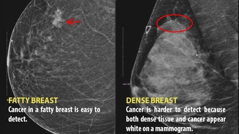 X-rays of two breasts. The one on the right has more white in the image which is obscuring a tumour that also appears white.