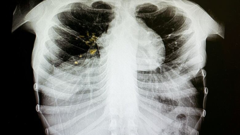 A x-ray shows tuberculosis in the lungs