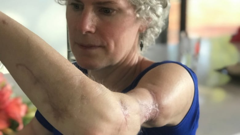 A woman holds up her arm which is covered in scars