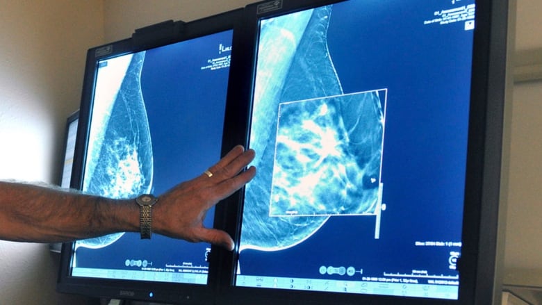 A hand with a gold watch on the wrist gestures toward a screen showing side-by-side mammogram images in shades of blue.