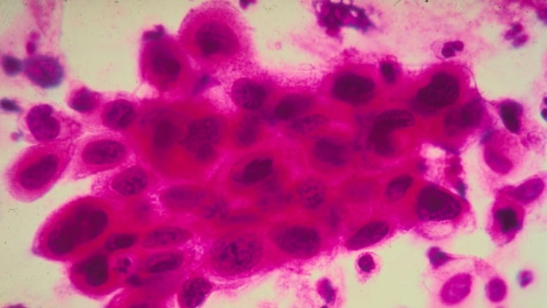 Close up of cancer cells in the cervix, stained pink under a microscope. 