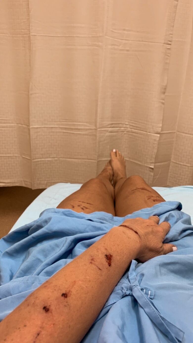 A woman's arms and legs are covered in gashes after an altercation with a raccooon.