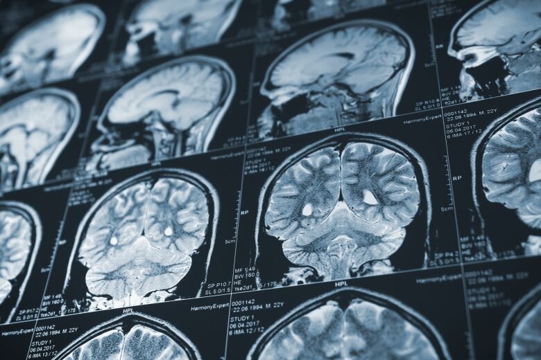 Close up series of a CT scan with human head on it. X-ray medicine concept.