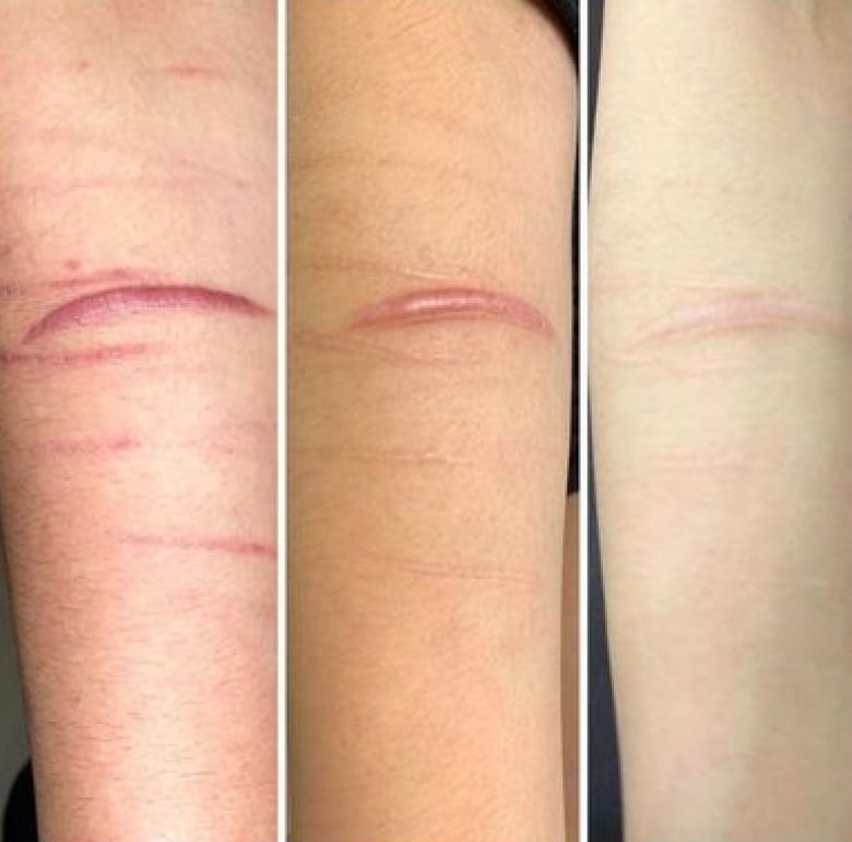 Self-harm scars are seen on someone's arm.