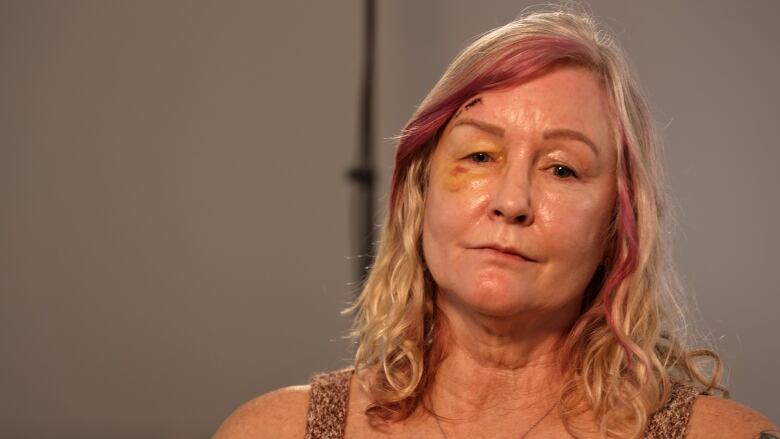 Bruises and stitches can be seen on Jill Thomson's face as she speaks with CBC News on December 20, 2022.