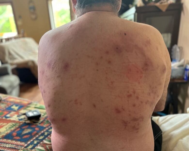 A man's back is seen with red swollen lumps from bug bites.