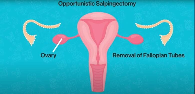 An illustration of the uterus, ovaries and fallopian tubes.