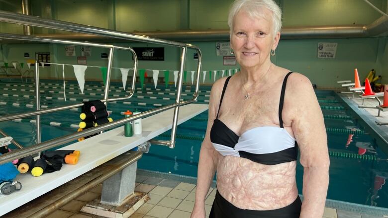 A woman in a black and white two-piece bathing suit with burn scars on her abdomen.