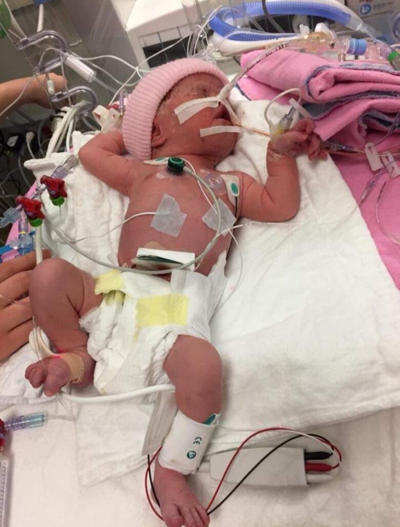 A photo of baby Rylee Warkentin in the NICU at a hospital in London, showing oxygen tubes and monitors. 