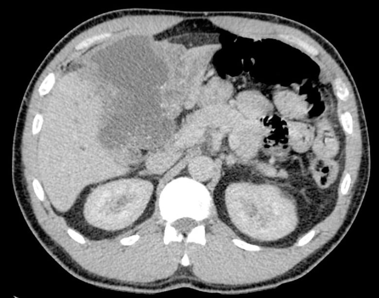 A black and white image shows black spots on the liver.