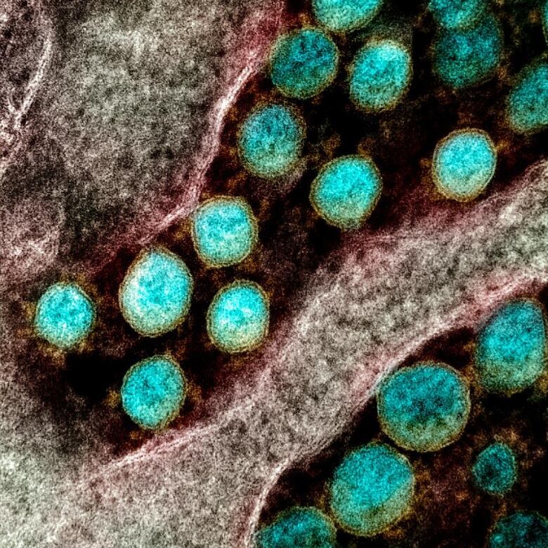 Transmission electron micrograph of SARS-CoV-2 virus particles, isolated from a patient.