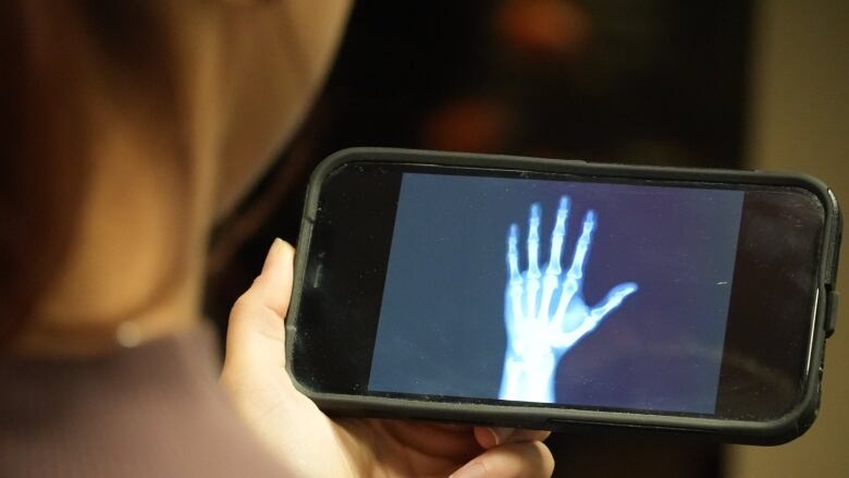 A person holds a phone with an X-ray on it.