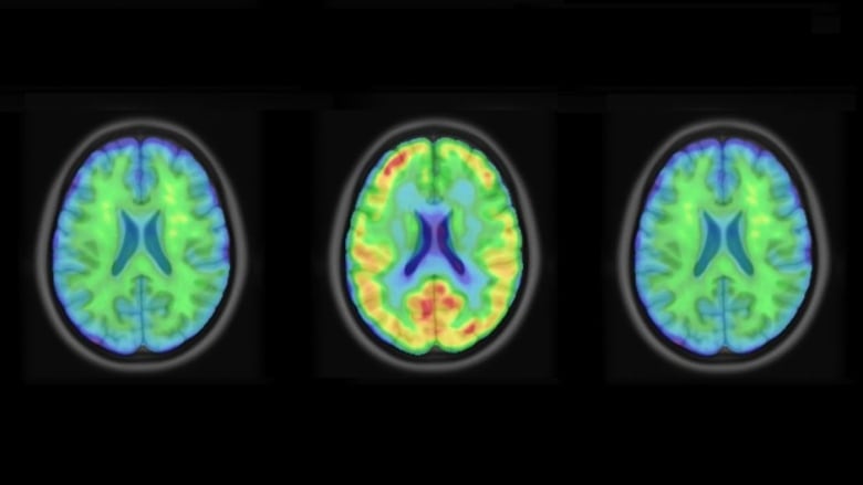 Three brain scans.