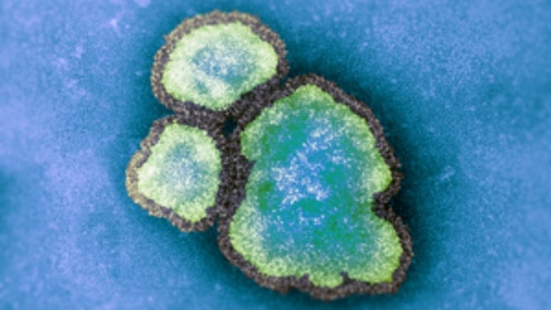 A colourized electron transmission micrograph of measles virus particles. 