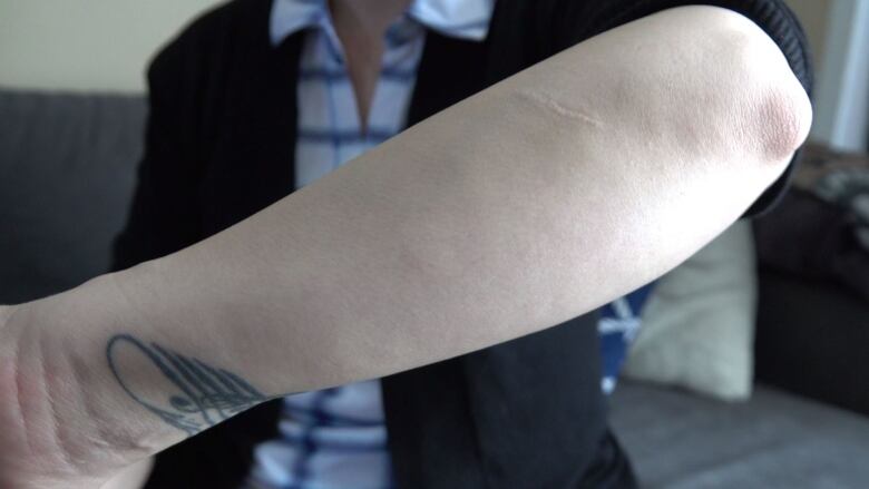 A woman hold her forearm up to the camera. Near her elbow is a thick scar.