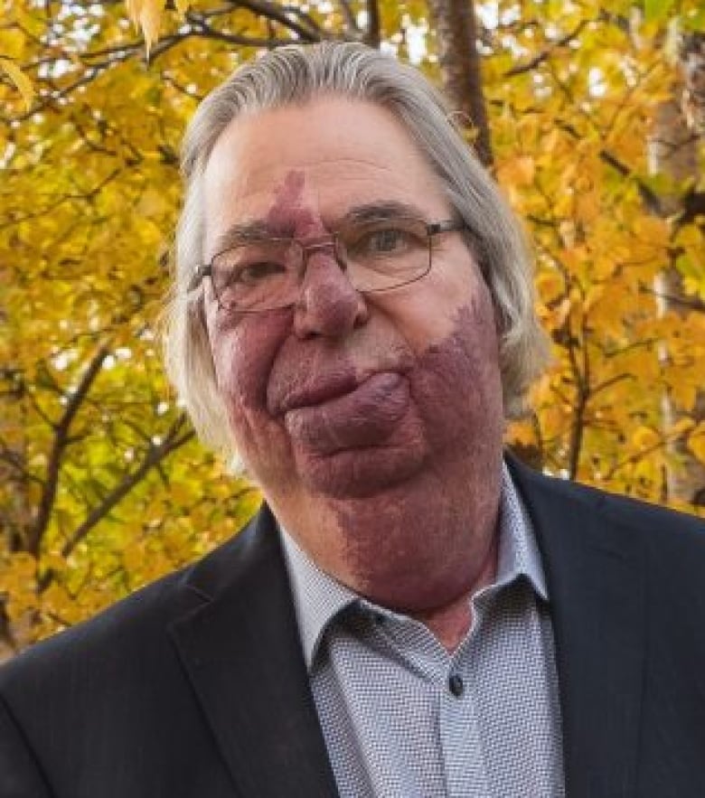 A man wearing a suit stands in front of a tree. The leaves are yellow like leaves in the fall. The man has a large birthmark covering the lower half of his face and neck.