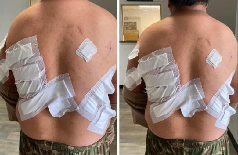 Two photos showing a back covered in bandages.