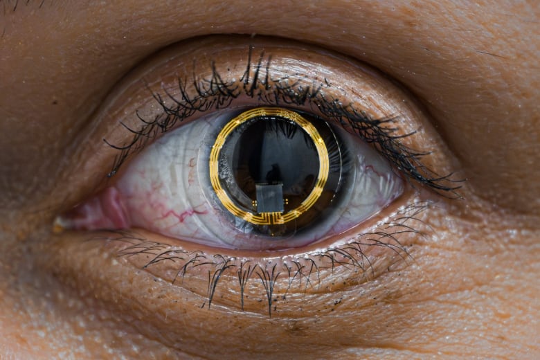 A close-up of an eye with a medical device circling the iris.