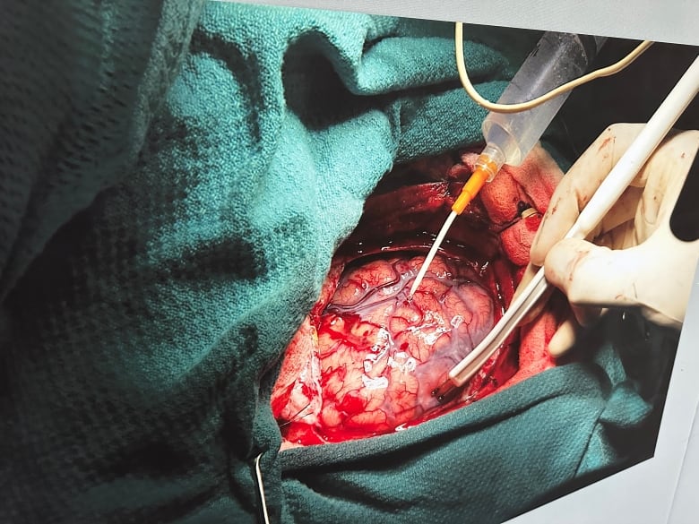 A photo of brain surgery.