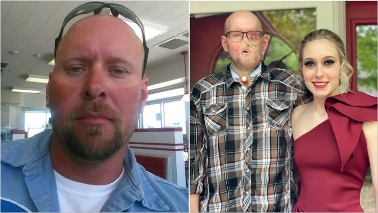 Two pictures, side by side. On the left, a selfie of a bald man with a beard. On the right, the same man stands outside with his arm around a teenage girl in a bright red gown. His nose, left eye, and lips are missing and his face is badly burned. 