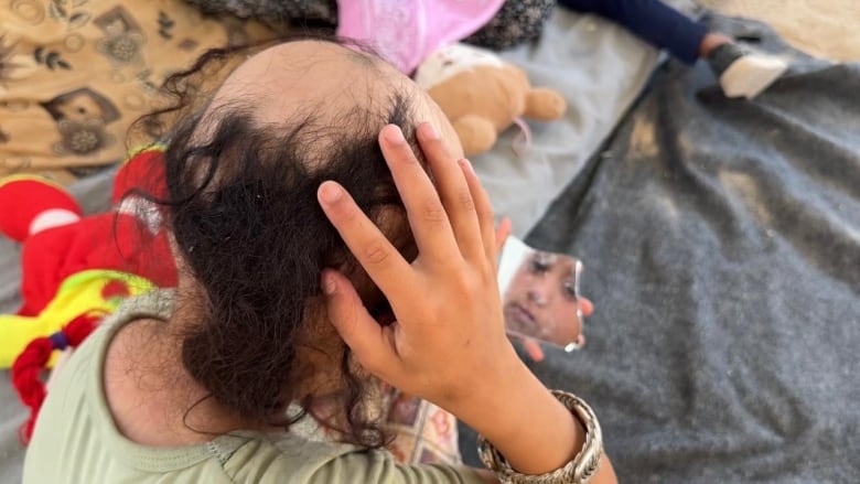 A child puts her hand on her balding head.