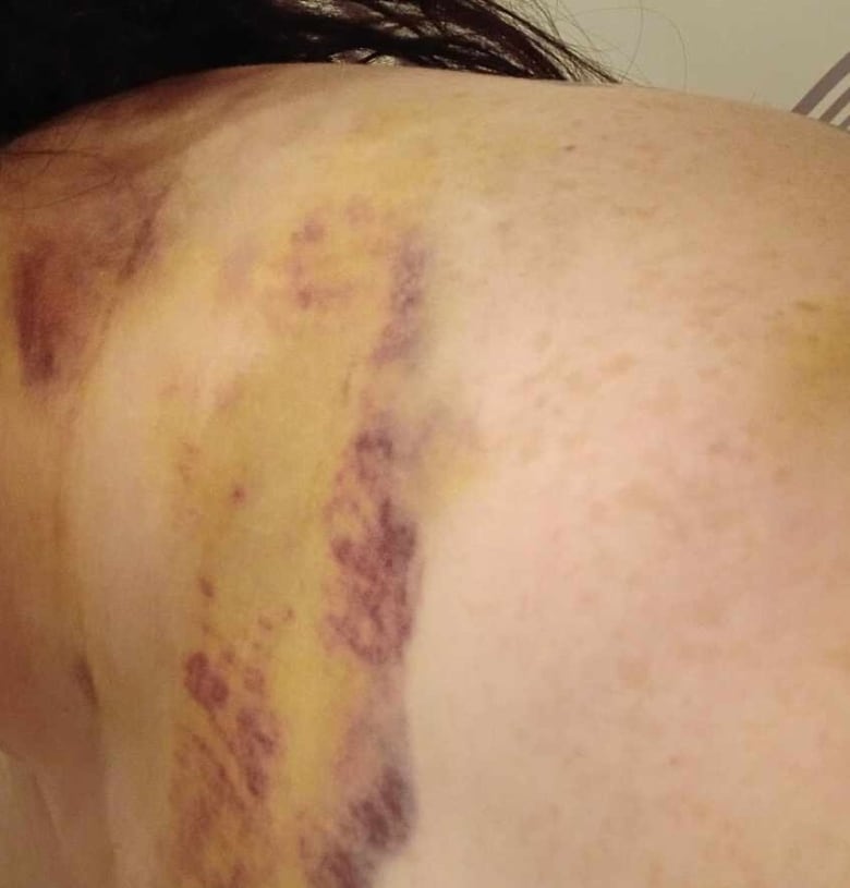 A large bruise