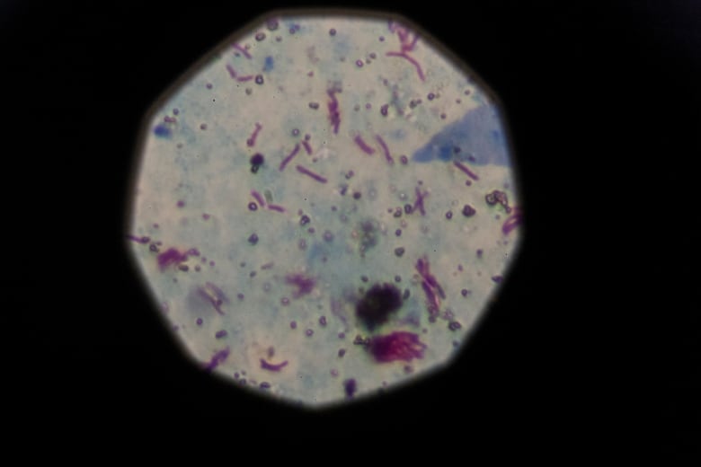 A sample that tested positive for tuberculosis is seen from a microscope.