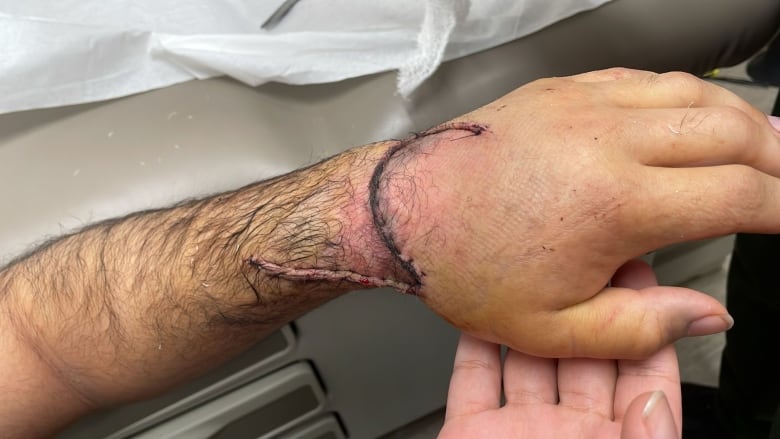 Close up of an arm and hand with fresh stitches